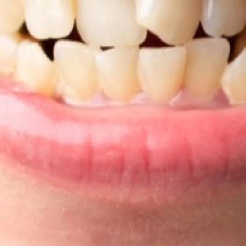 Les dents ne sont pas bien alignées